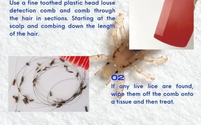 What to do to treat head lice.